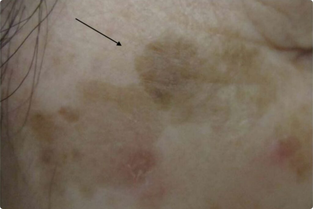 トレチノインとレチノールの違いは何ですか?